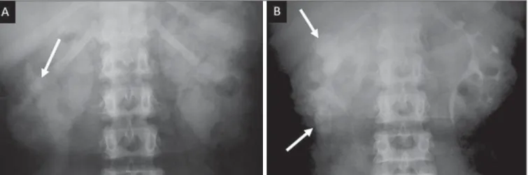 Figure 13. Renal tuberculosis at right. Plain radiography demonstrates spotted calcifications (arrow on A)