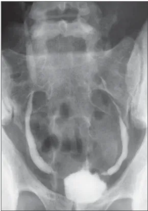 Figure 17. Vesical tuberculosis. CT identifies diffuse and asymmetrical thicken- thicken-ing of the vesical wall (arrows).