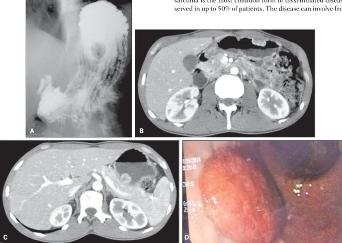 Figure 1. A: Radiographic image of esophagus, stomach and duodenum shows polypoid filling defect