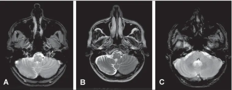 Figura 1. RM do encéfalo. Imagem axial ponderada em T2 FFE no nível do bulbo (A) e axial T2 (B) mostra hipersinal na região do núcleo olivar inferior esquerdo, bem como acentuação dos sulcos no hemisfério cerebelar direito