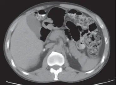 Figure 1. Abdominal CT, portal phase showing enlarged left suprarenal gland.