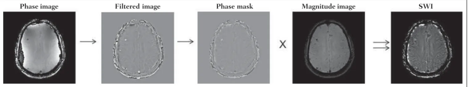 Figure 1. Diagram describing SWI processing with sigmoid mask. Patient with calcification deposit.