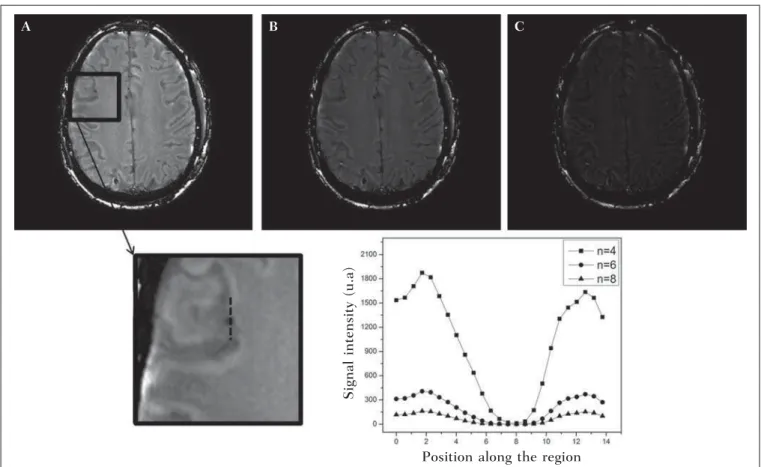 Figure 4. Susceptibility-weighted images of a patient with hemosiderin deposit (indicated with the dashed line), with different sigmoid mask multiplications A: n = 4;