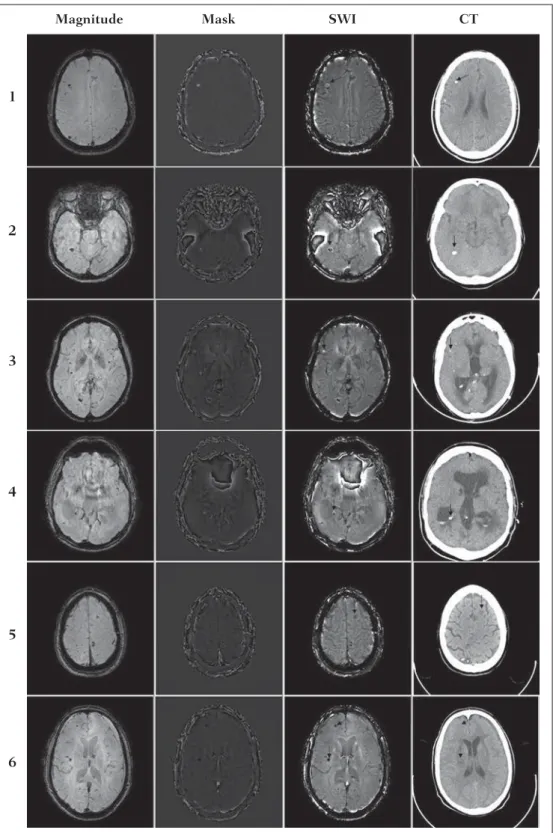 Figure 6. Magnitude, mask (multiplied 4 times), SWI and CT images on each one of the columns for all the individuals involved in the present study