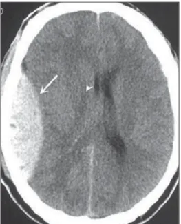 Figure 8.  A: DAI with focus of hyper- hyper-density on the grey-white interface (arrow).
