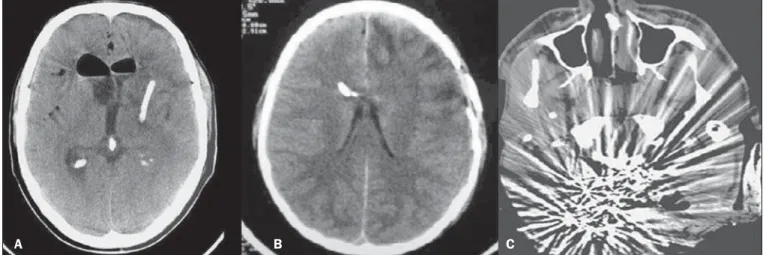 Figure 12. Left parietal drain (A), intracranial pressure catheter (B), artifacts (C).