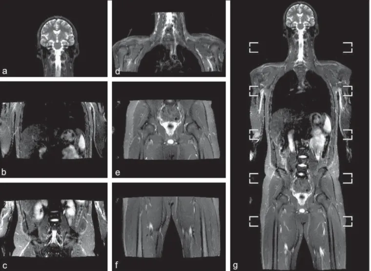 Figure 1. Image acquisition. Re-staging of a 18-year-old boy with lymphoma. STIR block imaging acquisition (a–f) and coronal single image reformatted using MRI system’s software (Philips