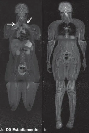 Figure 6. Staging of 17-year-old patient with lymphoma, presenting with enlarge- enlarge-ment of multiple cervical and mediastinal lymph nodes (arrows) (a)