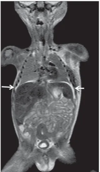 Figure 10. Virtual autopsy (coronal T2-weighted image) of a 26-week fetus with agenesis of the corpus callosum