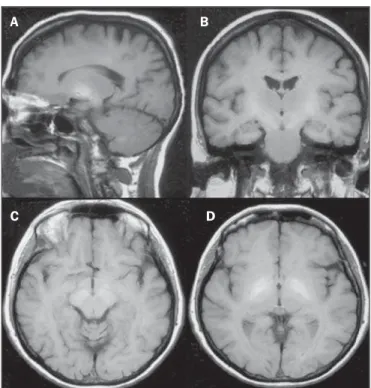 Figure 1. Wernicke syndrome. Female, 47-year-old patient. Coronal FLAIR (A) and axial T2-weighted (B,C) images show hypersignal foci in the periacqueductal gray substance, thalami in paramedian region, mammillary bodies (arrows),  tec-tum and tegmentec-tum