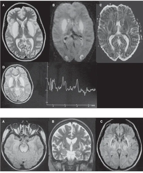 Figure 4. Methanol intoxication. Fe- Fe-male, 25-year-old patient. Bilateral, symmetrical putaminal hypersignal on T2-weighted FLAIR image (A) diffusion restriction, hypersignal on  diffusion-weighted image (B) and hyposignal on ADC map (C)