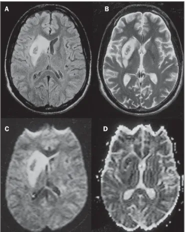 Figure 6. Ischemic stroke/arteritis with infarction caused by use of cocaine.