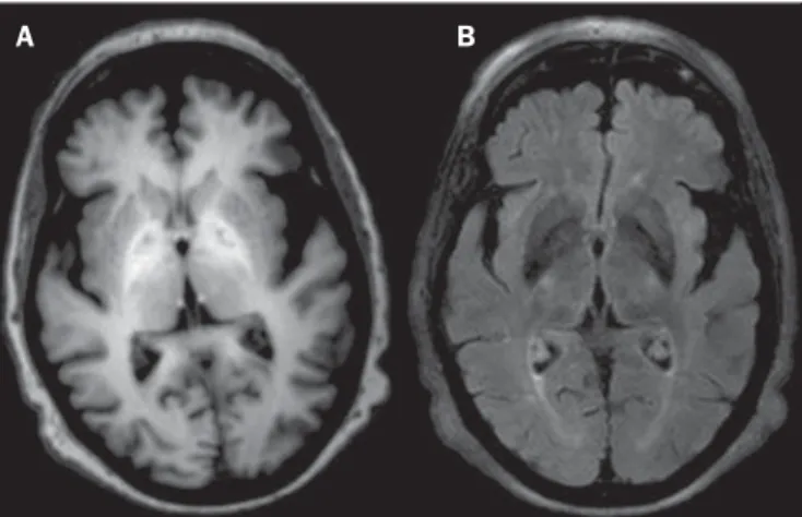 Figure 8. Patient with chronic renal failure undergoing prolonged dialysis treat- treat-ment did not present hepatopathy
