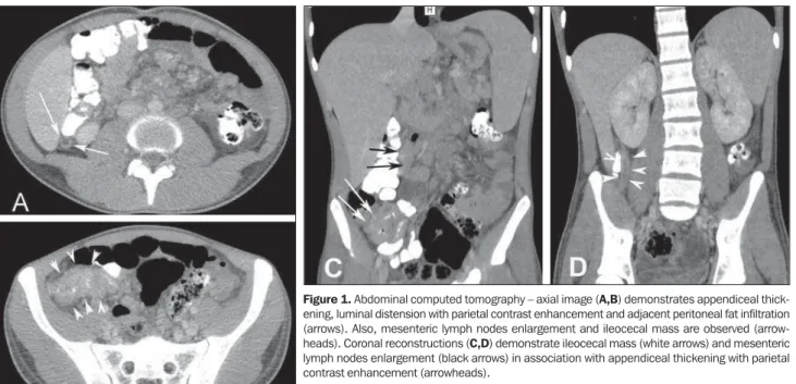 Figure 1. Abdominal computed tomography – axial image (A,B) demonstrates appendiceal thick- thick-ening, luminal distension with parietal contrast enhancement and adjacent peritoneal fat infiltration (arrows)