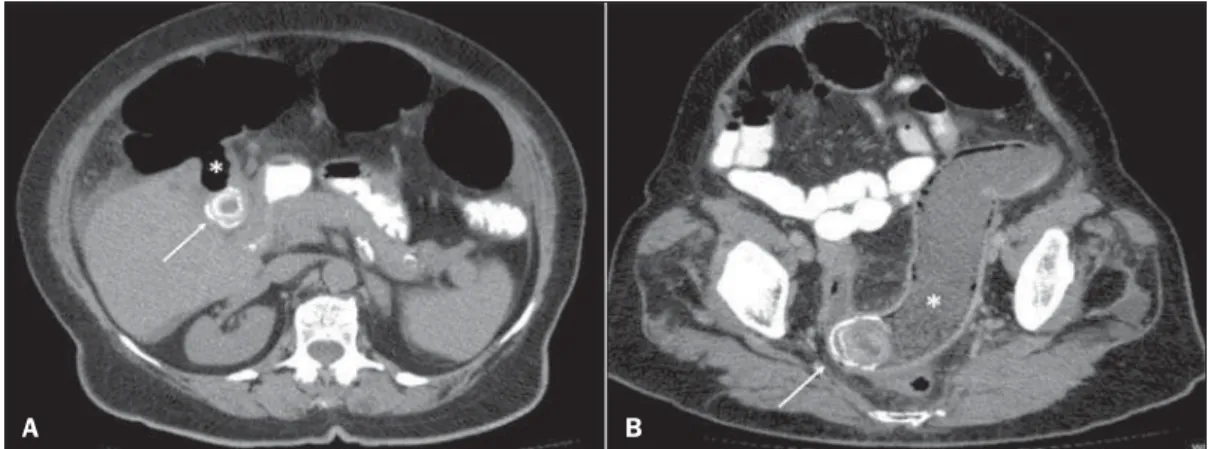 Figure 1.  A: Axial CT image demonstrating the presence of a calculus in the gallbladder  (ar-row) and fistulous tract  commu-nicating the gallbladder with the large bowel (asterisk)
