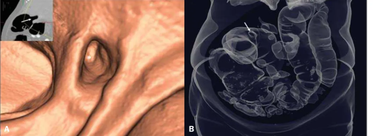 Figure 2. A: Endoluminal 3D reconstruction of virtual  colono-scopy image demonstrating the fistulous orifice (asterisk) in the large bowel