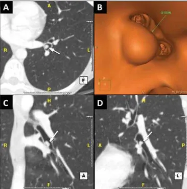 Figure 1. A: CT image shows an endobronchial nodule (arrows) in the lateral basal bronchus of the left lower lobe