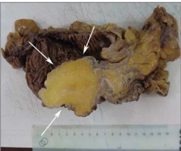 Figura 1. TC corte axial (A) e reformatação no plano coronal (B) mostrando tumor com densidade de gordura no cólon transverso (setas), de contornos bosselados,  pre-dominantemente lipomatoso, medindo cerca de 9 cm no seu maior diâmetro transverso, e sinais