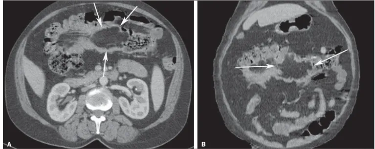 Figure 1. Axial CT section (A) and coronal reformation (B).
