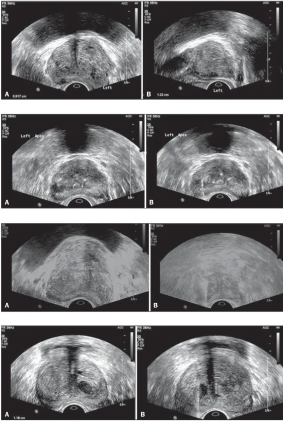 Figure 1. True positive prostate nodule.