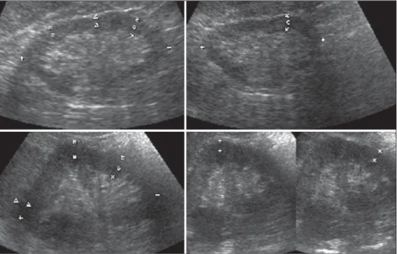 Figure 1. Sonographic images describ- describ-ing how renal cortex and parenchyma thicknesses as well as bipolar length were obtained.