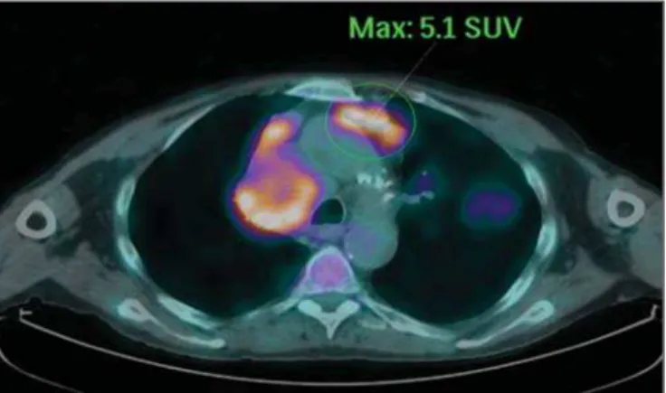 Figure 1. Female, 64-year-old patient with diagnosis of pulmonary adenocarci- adenocarci-noma in the right upper lobe