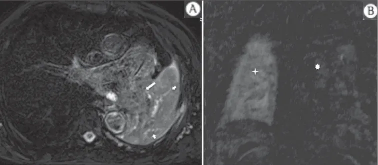 Figure 4. Male, 75-year-old patient with chronic obstructive pulmonary disease and previous history of lung cancer resection for two years
