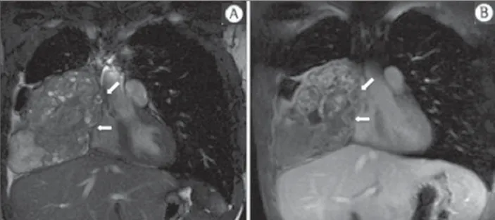 Figure 7. Male, 71-year-old patient with spinocellular carcinoma of the lung. On A, chest CT demonstrates lytic lesion with soft parts component in the left vertebral hemibody (arrow) of an inferior thoracic  ver-tebra