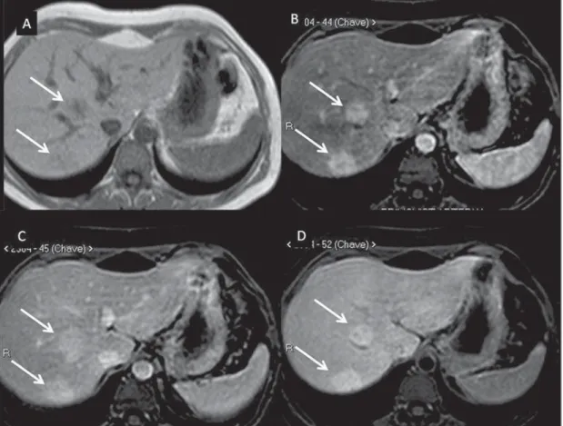 Figure 1. FNH (diagnosis based on histological  analy-sis after percutaneous  bi-opsy)