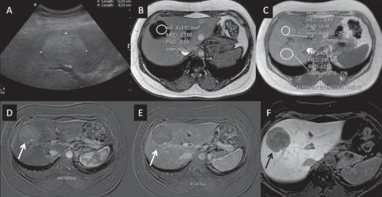 Figure 2. Hepatic adenoma (diagnosis based on histological analysis after percutaneous biopsy)