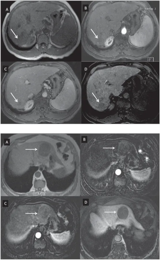 Figure 3. Infiltrative and undifferentiated HCC (confirmed by percutaneous biopsy).