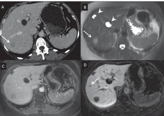 Figure 5. Liver metastasis from breast neoplasm (diagnosis based on periodic follow-up)