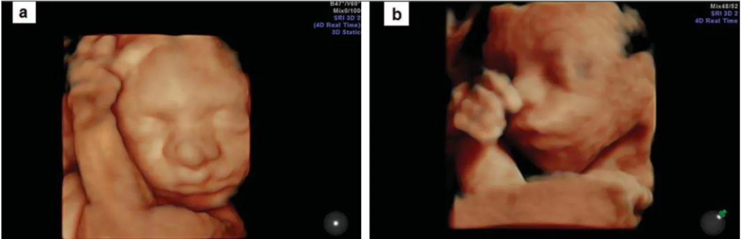 Figure 4. 3D HD live rendered image of two fetuses with gestational age of 24 weeks and 3 days