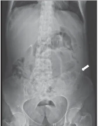 Figure 1. Anteroposterior abdominal radiography demonstrating radiopaque, elon- elon-gated structures in the region of the bowel loops (arrow) and gaseous distention of small bowel loop in the center of the abdomen.
