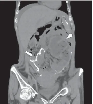 Figure 4. Sagittal abdominal CT section showing thickening and calcification of intestinal and peritoneal walls (arrow)