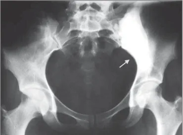 Figura 2. Radiografia da bacia mostra hiperostose do ilíaco (seta) e sacro, à esquerda, aspecto semelhante ao do membro superior.