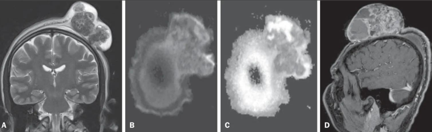 Figura 1. A: Imagem coronal, sequência T2 mostrando tumor na região parietal esquerda com predomínio de hipossinal, com áreas de degeneração cística/necrose de permeio