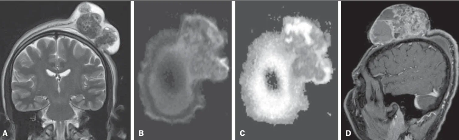 Figure 1. A: Coronal, T2-weighted sequence showing a tumor in the left parietal region with predominance of hyposignal, intermingled with areas of cystic/necrotic degeneration