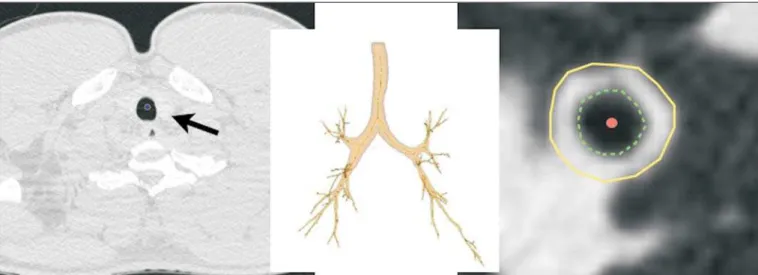 Table 1 summarizes the spirometry results. Groups I and II showed significant differences in pulmonary function  mea-sures, including FEV1, FEV1%, forced vital capacity (FVC,