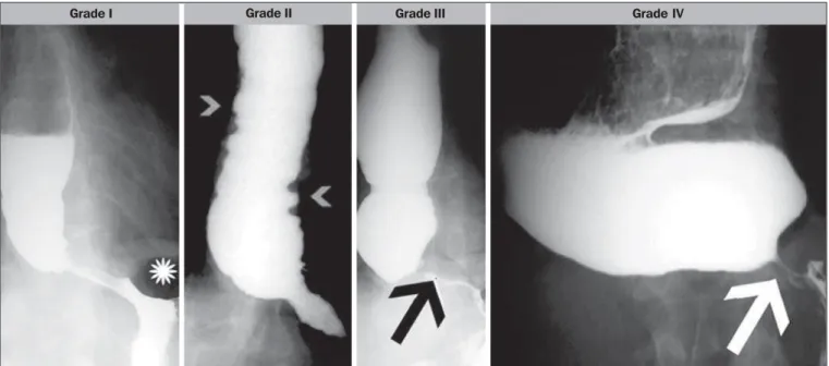 Figure 1. Rezende’s classification. Grade I – esophageal hypotonia and gastric air bubble (asterisk)