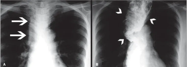 Figure 3. Grade IV megaesophagus. A: Posteroanterior X-ray showing widening of the superior mediastinum (arrows)