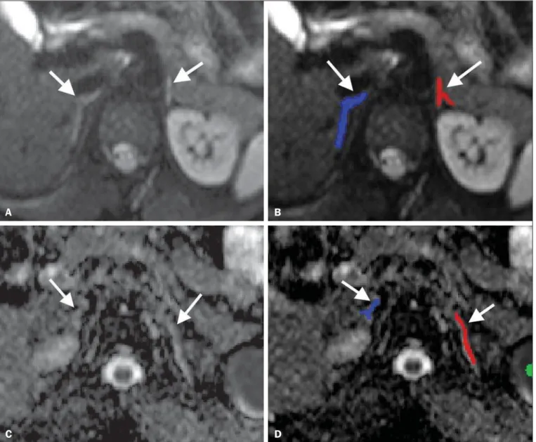 Figure 1. Segmentation of the adrenal glands. Example of how to segment the adrenal glands and co-register DW-MRI with the ADC map