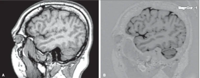 Figure 1. Sagittal images of the lateral fissure at its deepest extent, obtained with the T1 GRE (A) and T1 IR GRE (B) techniques.