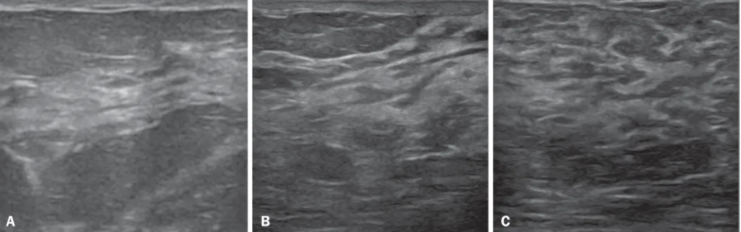 Figure 1. A: Breast in the first trimester of pregnancy: predominantly hypoechoic breast parenchyma, showing dilatation of the milk ducts