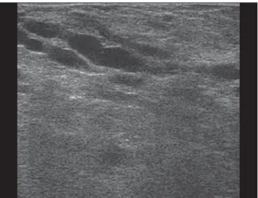 Figure 2. Breast during lactation. Diffusely hyperechoic breast parenchyma, with ductal dilatation due to the accumulation of milk.