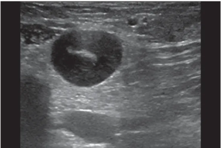 Figure 4. Abscess. A: Amor- Amor-phous, unilocular complex  le-sion, with ill-defined borders, parallel to the skin,  heteroge-neous, with variable  echo-genicity, that is predominantly hypoechoic, with discrete  pos-terior acoustic enhancement, correspond