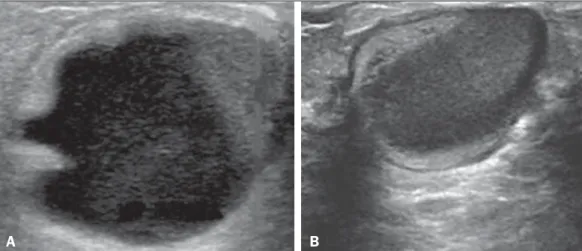 Figure 6. Granulomatous mastitis. Amorphous formation, not parallel to the skin, with ill-defined, hypoechoic borders.