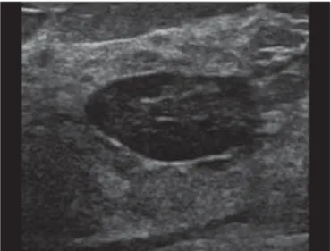Figure 8. Lactating adenoma. Ovoid nodule, parallel to the skin, with a heteroge- heteroge-neous, hypoechoic pattern and well-defined borders.