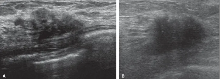 Figure 10. Pregnancy-associated breast cancer. A: Amorphous formation, parallel to the skin, with variable echogenicity (predominantly hypoechoic), a heterogeneous texture, discrete acoustic enhancement and poorly defined borders