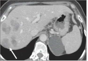 Figure 3. Gallbladder involvement by lymphoma. Axial CT of the abdomen, show- show-ing marked parietal thickenshow-ing of the gallbladder (broad arrow), together with periportal lymphomatous infiltration (narrow arrow).